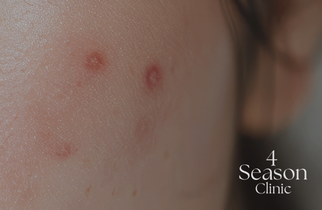 포시즌의원 여드름 치료 (경도)